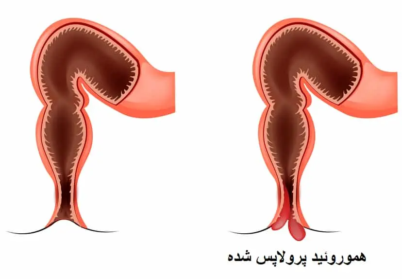 بیرون زدگی بواسیر