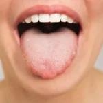 زن مبتلا به برفک دهان