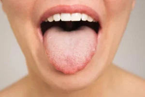 زن مبتلا به برفک دهان