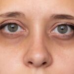 تیرگی زیر چشم های زن جوان