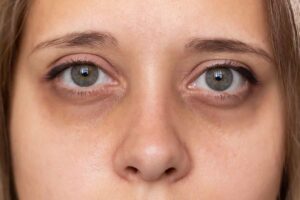 تیرگی زیر چشم های زن جوان