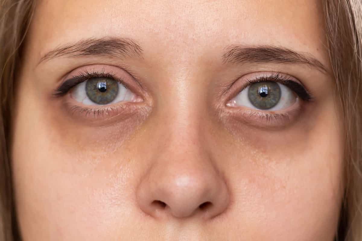 تیرگی زیر چشم های زن جوان