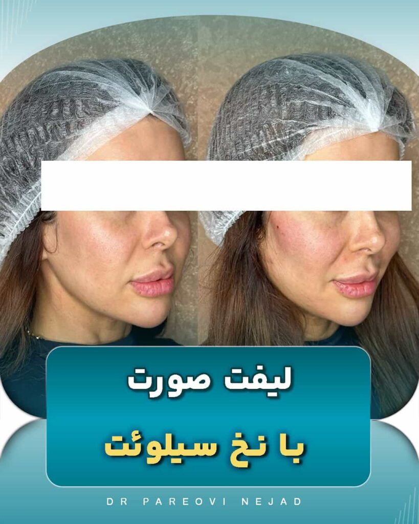 لیفت با نخ سیلوئت