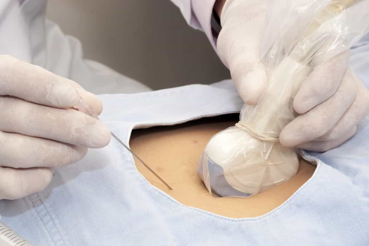 نمای نزدیک از انجام بیوپسی معده