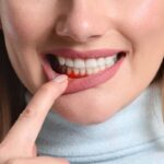 التهاب لثه در بارداری