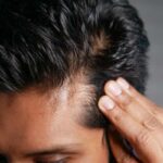 قرص فیتو برای ریزش مو