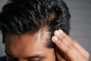 قرص فیتو برای ریزش مو