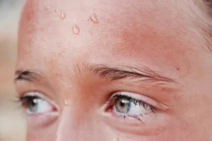 عرق زیاد سر و صورت