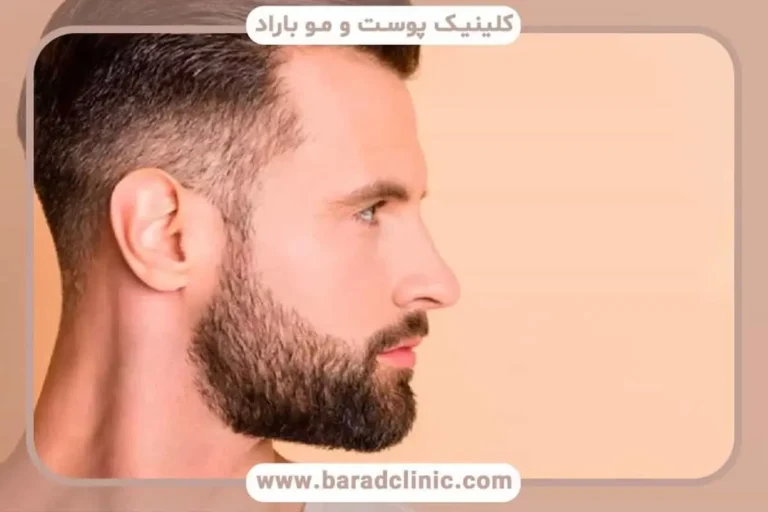 کاشت ریش مناسب چه افرادی است؟ شرایط و هزینه‌ها