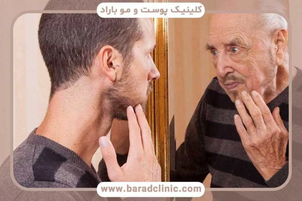 کاشت ریش