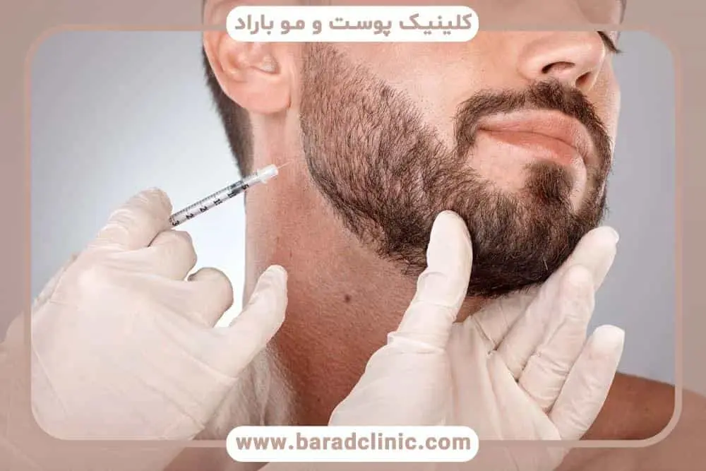 کاشت ریش