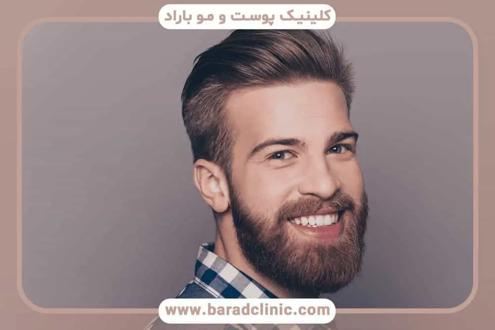 کاشت ریش