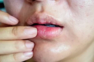 لب ترک خورده