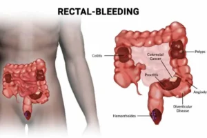 Why Do I Have Bright Red Blood In My Stool? - NYC Gastroenterologist | Manhattan Gastroenterology