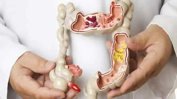 Rectal Bleeding Diagnosis, Management, and Treatment - Gastroenterologists  In Florida