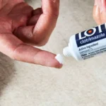 پماد کلوتریمازول