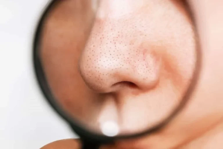 جوش سر سیاه بینی