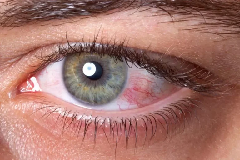 خونریزی شبکیه چشم