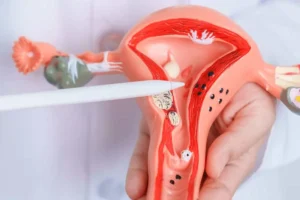 چسبندگی رحم