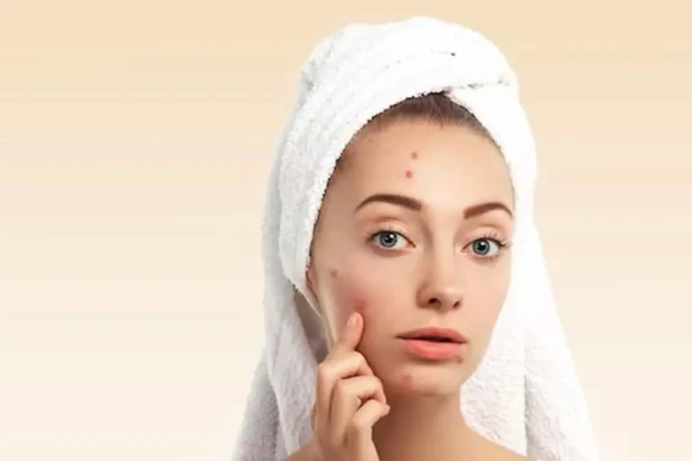 از بین بردن جای جوش در یک روز امکان پذیر است؟ 