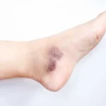 علت تیرگی قوزک پا در زنان و نحوه رفع آن