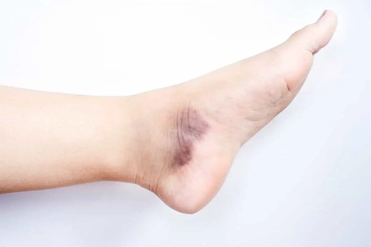 علت تیرگی قوزک پا در زنان و نحوه رفع آن