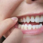 عوارض و خطرات تحلیل لثه را بشناسید