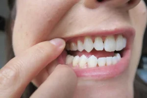 عوارض و خطرات تحلیل لثه را بشناسید