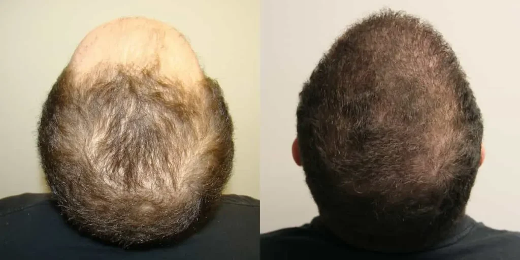 قبل و بعد از فیلر مو