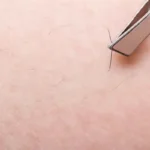 موی زیرپوستی چرا ایجاد می‌شود و چگونه آن را از بین ببریم؟