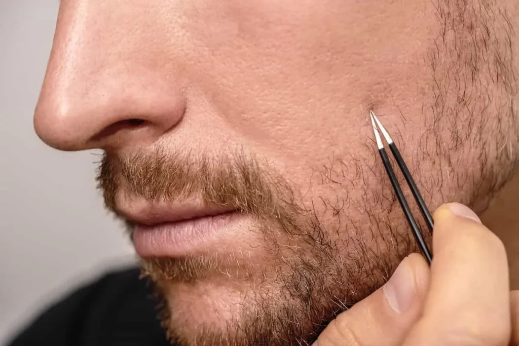 موی زیرپوستی صورت