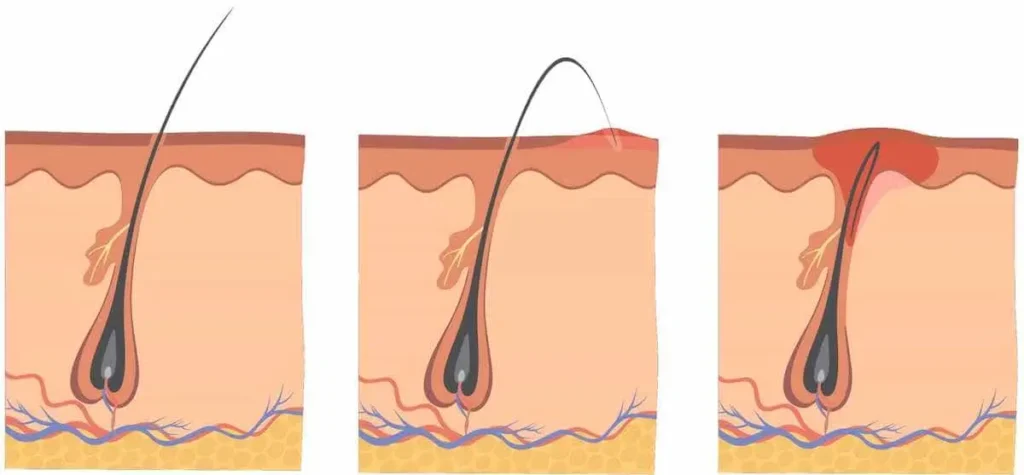 نحوه ایجاد موی زیرپوستی