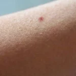 نحوه از بین بردن موهای زیرپوستی بعد از لیزر