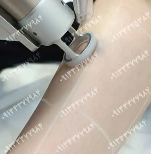 مراقبت‌های قبل و بعد از لیزر موهای زائد در اصفهان