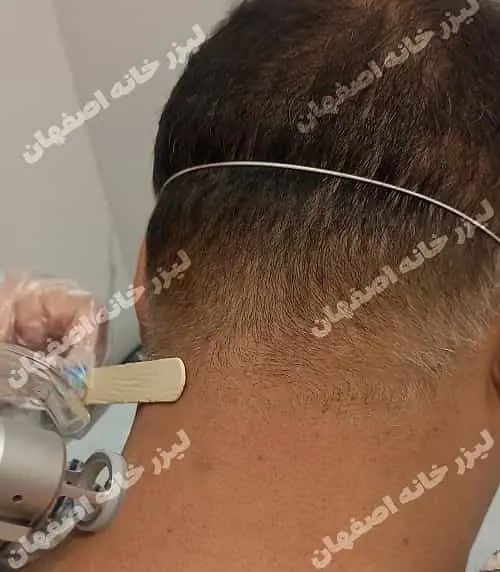 مراقبت‌های قبل و بعد از لیزر موهای زائد در اصفهان