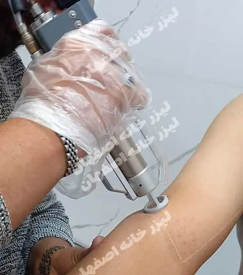 مراقبت‌های قبل و بعد از لیزر موهای زائد در اصفهان