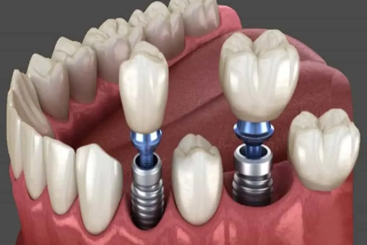 ایمپلنت در بیمارستان میلاد: هزینه، مزایا و شرایط انجام درمان