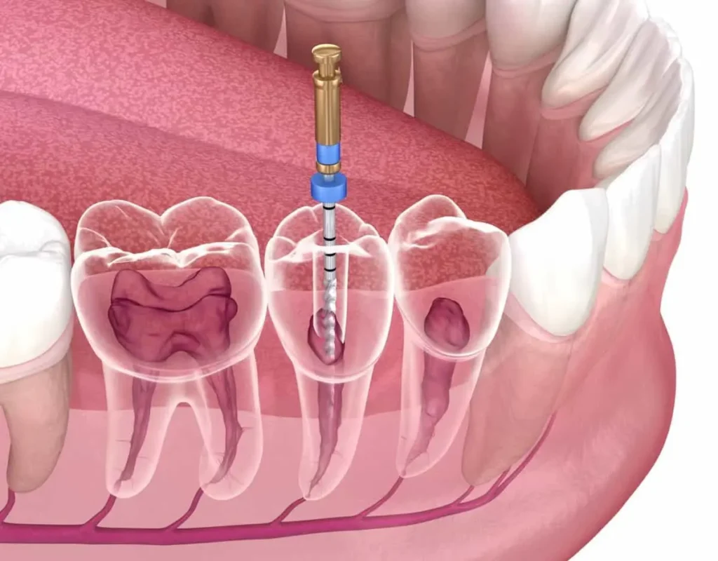 درمان ریشه دندان