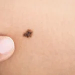 سرطان پوست چیست؟ نحوه تشخیص و تفاوت با مشکلات پوستی دیگر