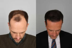 آیا زینک برای درمان و جلوگیری از ریزش مو مفید است؟