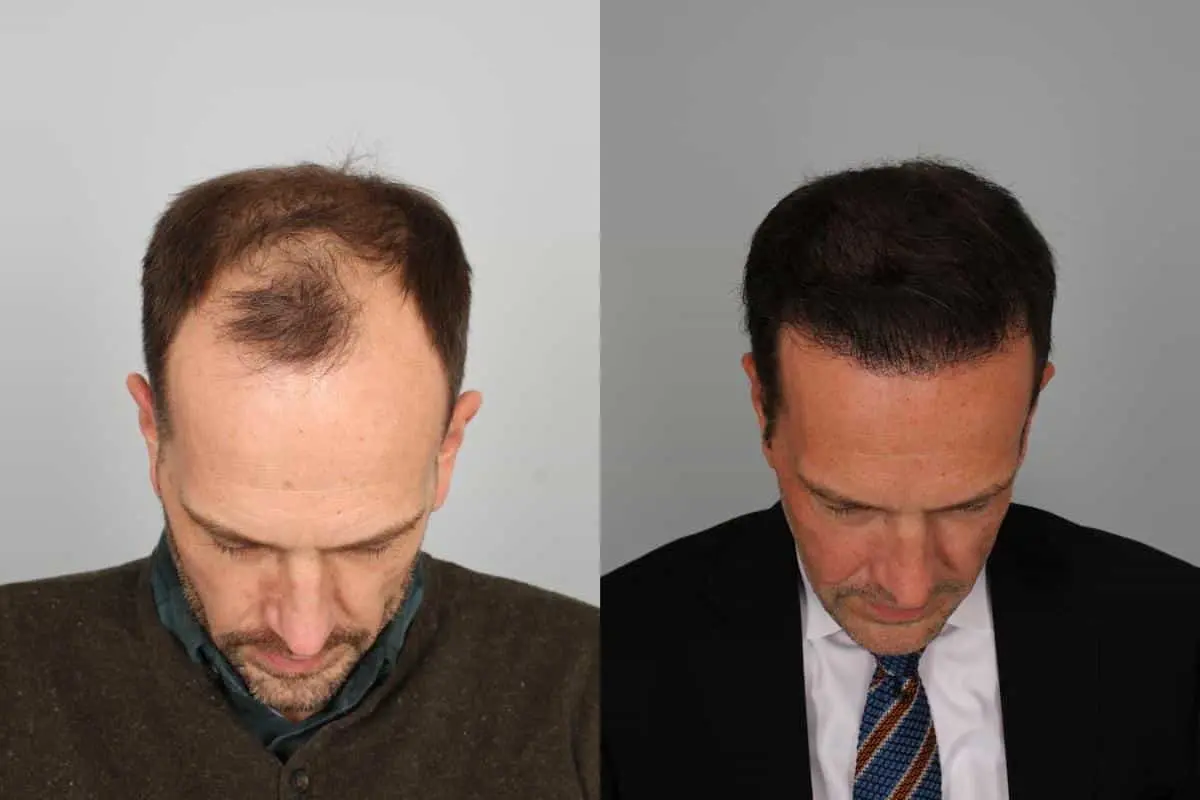 آیا زینک برای درمان و جلوگیری از ریزش مو مفید است؟