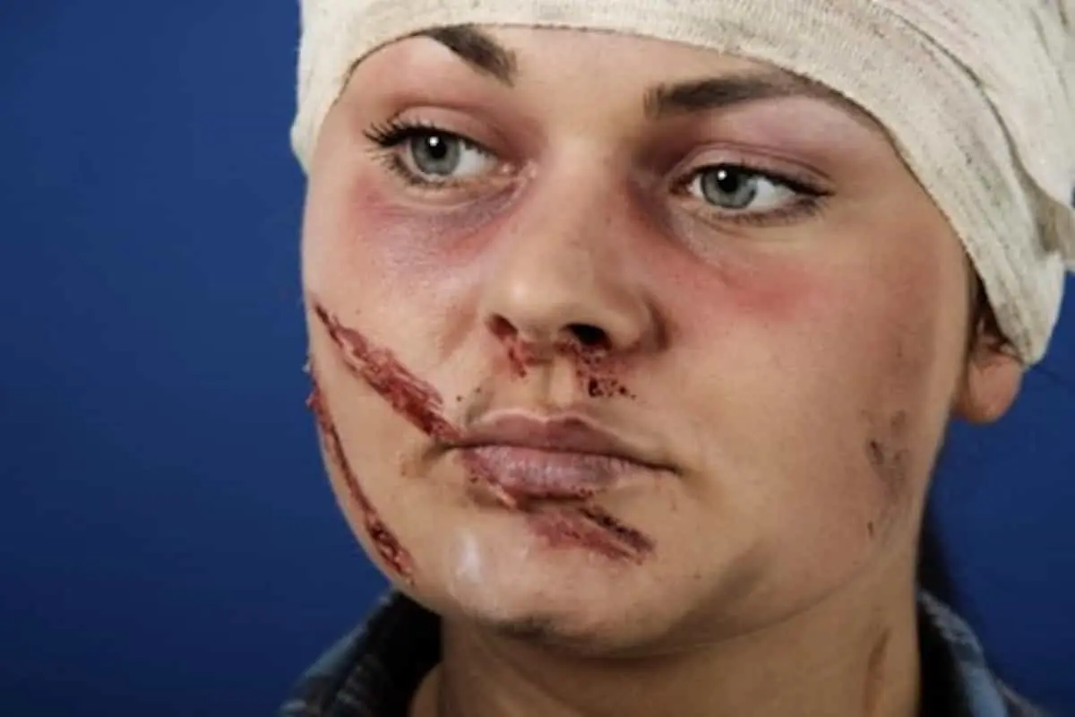 تفاوت دیه در آسیبهای مختلف ناحیه فک و صورت؛ راهنمای کامل و بهروزرسانیشده ۱۴۰۴