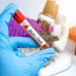 میزان نرمال اوره خون چقدر است؟