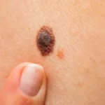 خال های پوستی سرطانی چگونه هستند و چه شکلی دارند؟