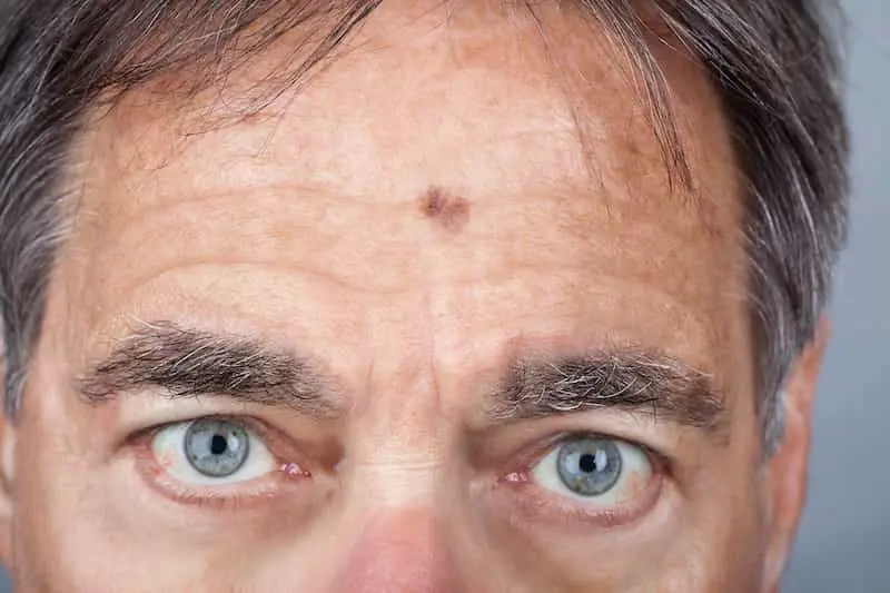 سرطان سلول بازال