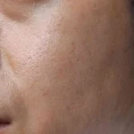 علت چرب شدن پوست صورت چیست؟