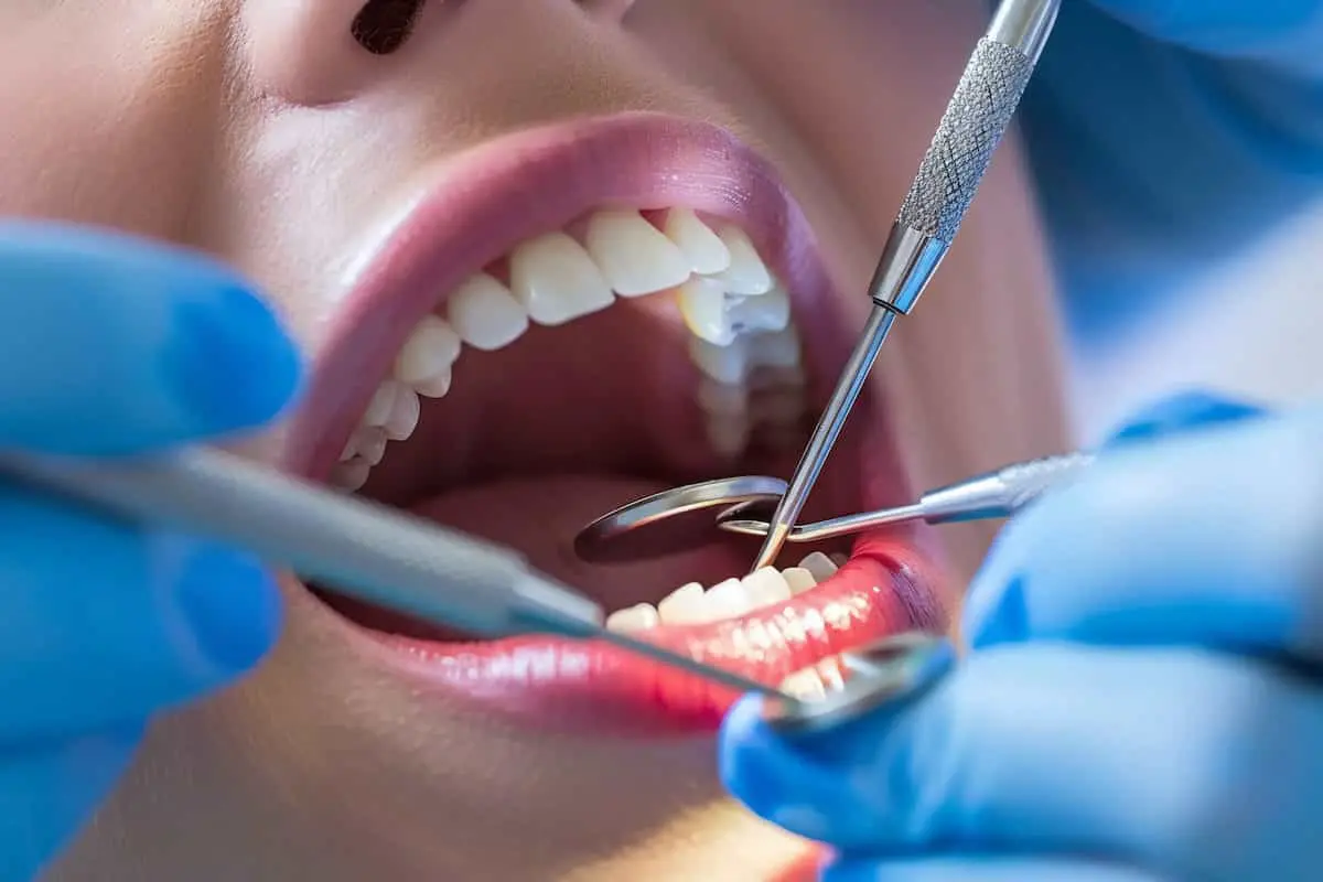 معایب کامپوزیت دندان؛ نکات پنهان این روش زیبایی