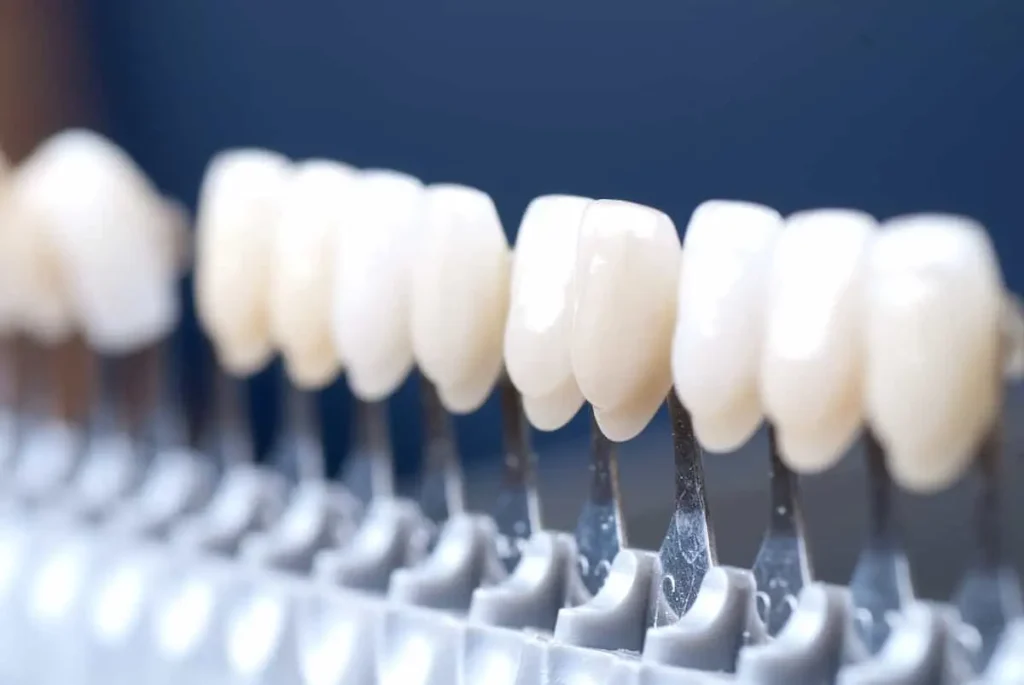 معایب کامپوزیت دندان؛ نکات پنهان این روش زیبایی