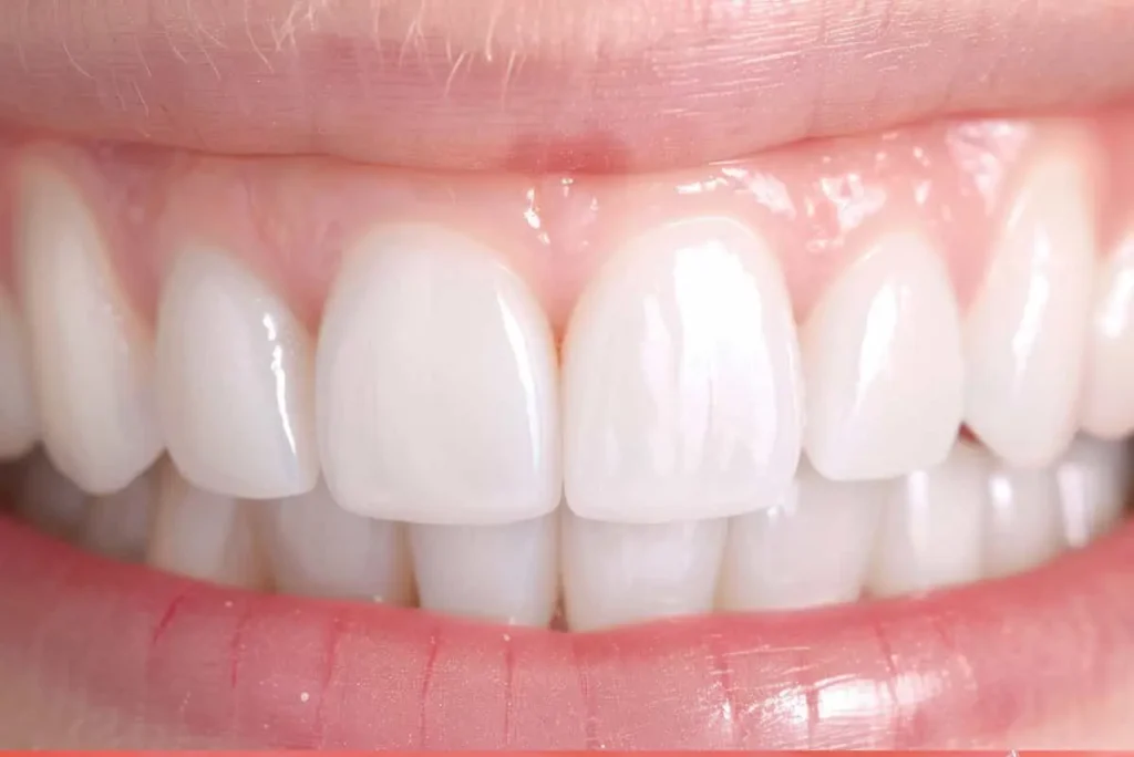 معایب کامپوزیت دندان؛ نکات پنهان این روش زیبایی