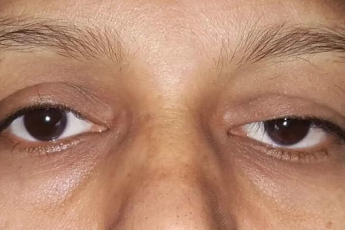 بررسی این‌که پتوز چشم چیست